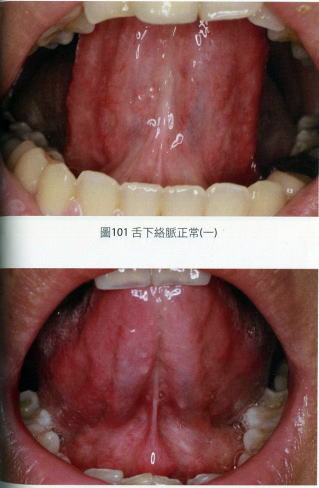 舌 の 裏 血管 写真